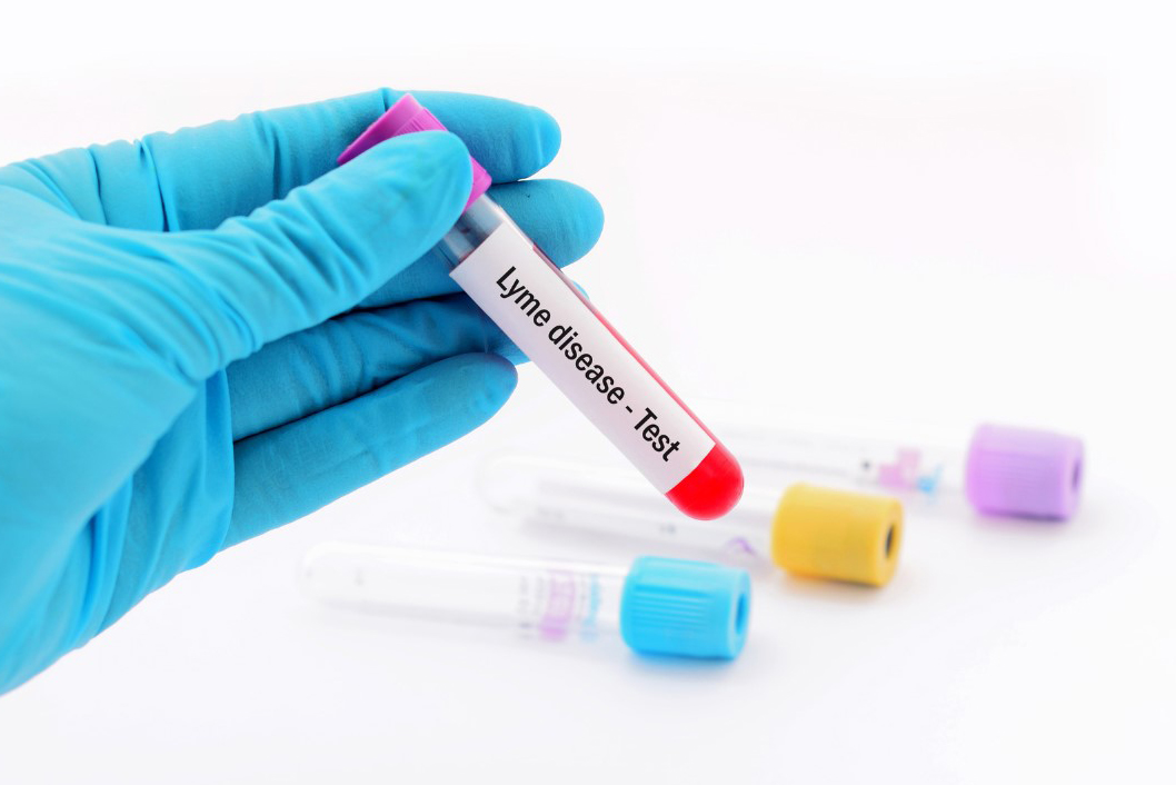 Lyme Disease Testing offered by Novalab in NJ
